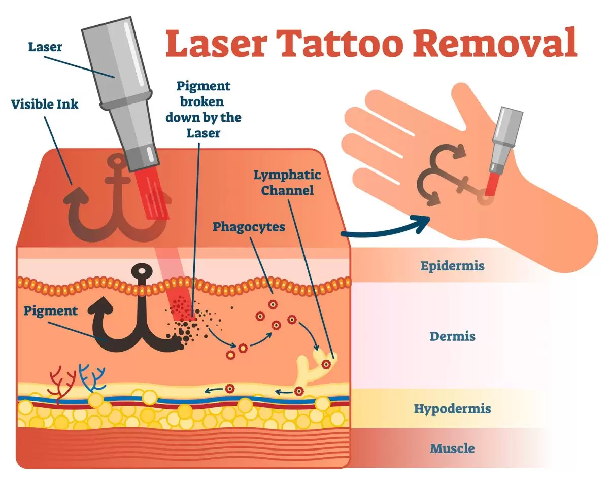 Tattoo-removal-visual-e1553215038310.jpg